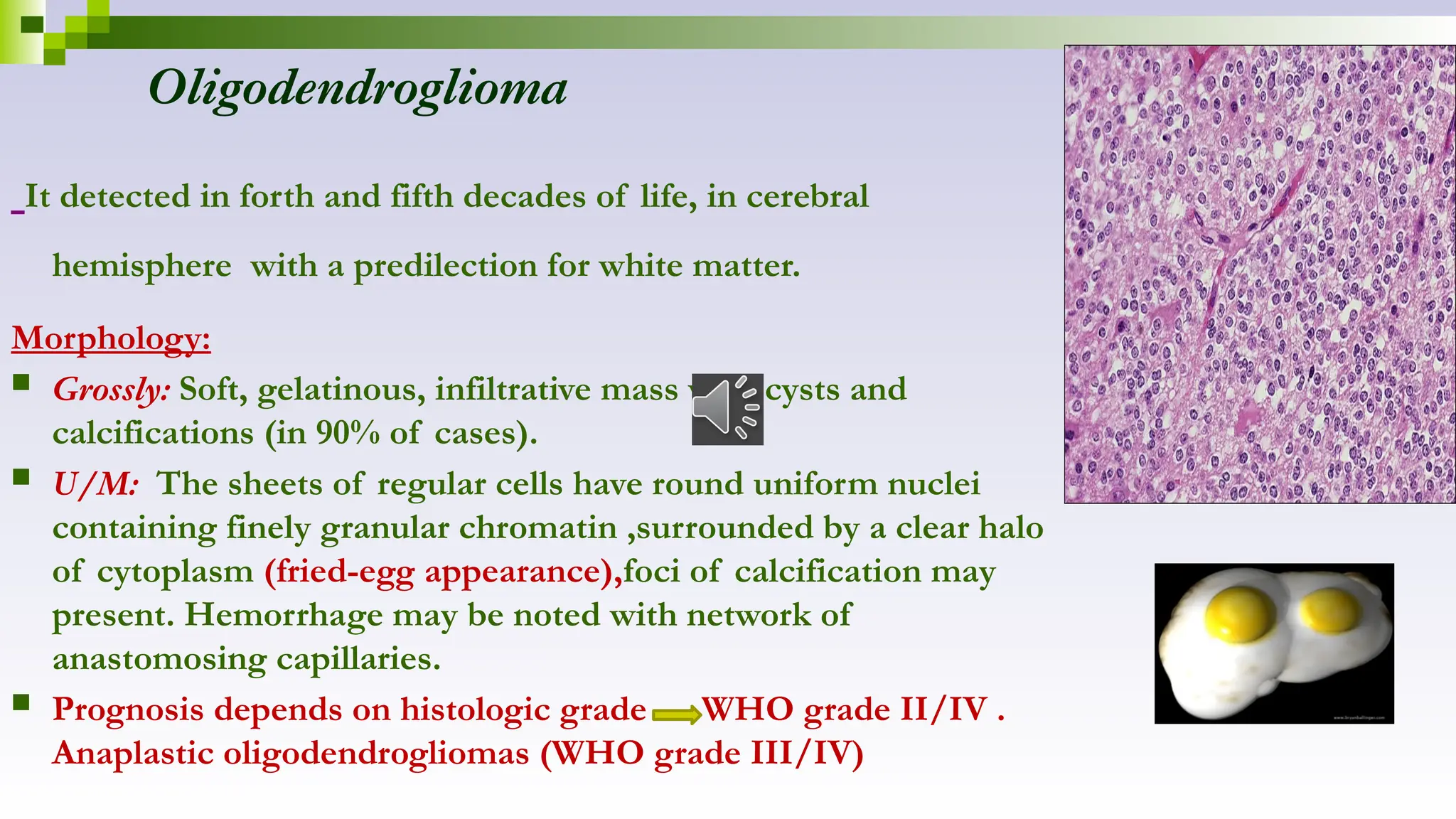 Oligodendroglioma
It detected in forth and fifth decades of life, in cerebral
hemisphere with a predilection for white matter.
Morphology:
 Grossly: Soft, gelatinous, infiltrative mass with cysts and
calcifications (in 90% of cases).
 U/M: The sheets of regular cells have round uniform nuclei
containing finely granular chromatin ,surrounded by a clear halo
of cytoplasm (fried-egg appearance),foci of calcification may
present. Hemorrhage may be noted with network of
anastomosing capillaries.
 Prognosis depends on histologic grade WHO grade II/IV .
Anaplastic oligodendrogliomas (WHO grade III/IV)
 
