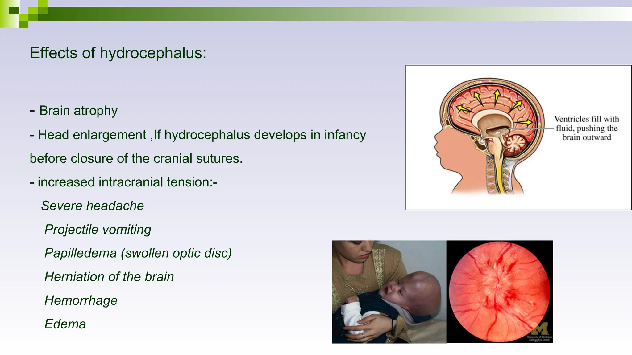 Effects of hydrocephalus:
- Brain atrophy
- Head enlargement ,If hydrocephalus develops in infancy
before closure of the cranial sutures.
- increased intracranial tension:-
Severe headache
Projectile vomiting
Papilledema (swollen optic disc)
Herniation of the brain
Hemorrhage
Edema
 