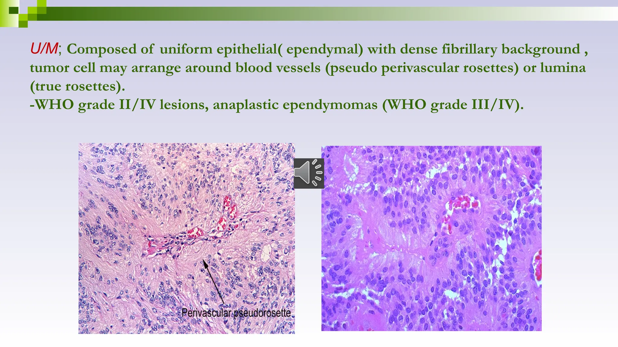 U/M; Composed of uniform epithelial( ependymal) with dense fibrillary background ,
tumor cell may arrange around blood vessels (pseudo perivascular rosettes) or lumina
(true rosettes).
-WHO grade II/IV lesions, anaplastic ependymomas (WHO grade III/IV).
 