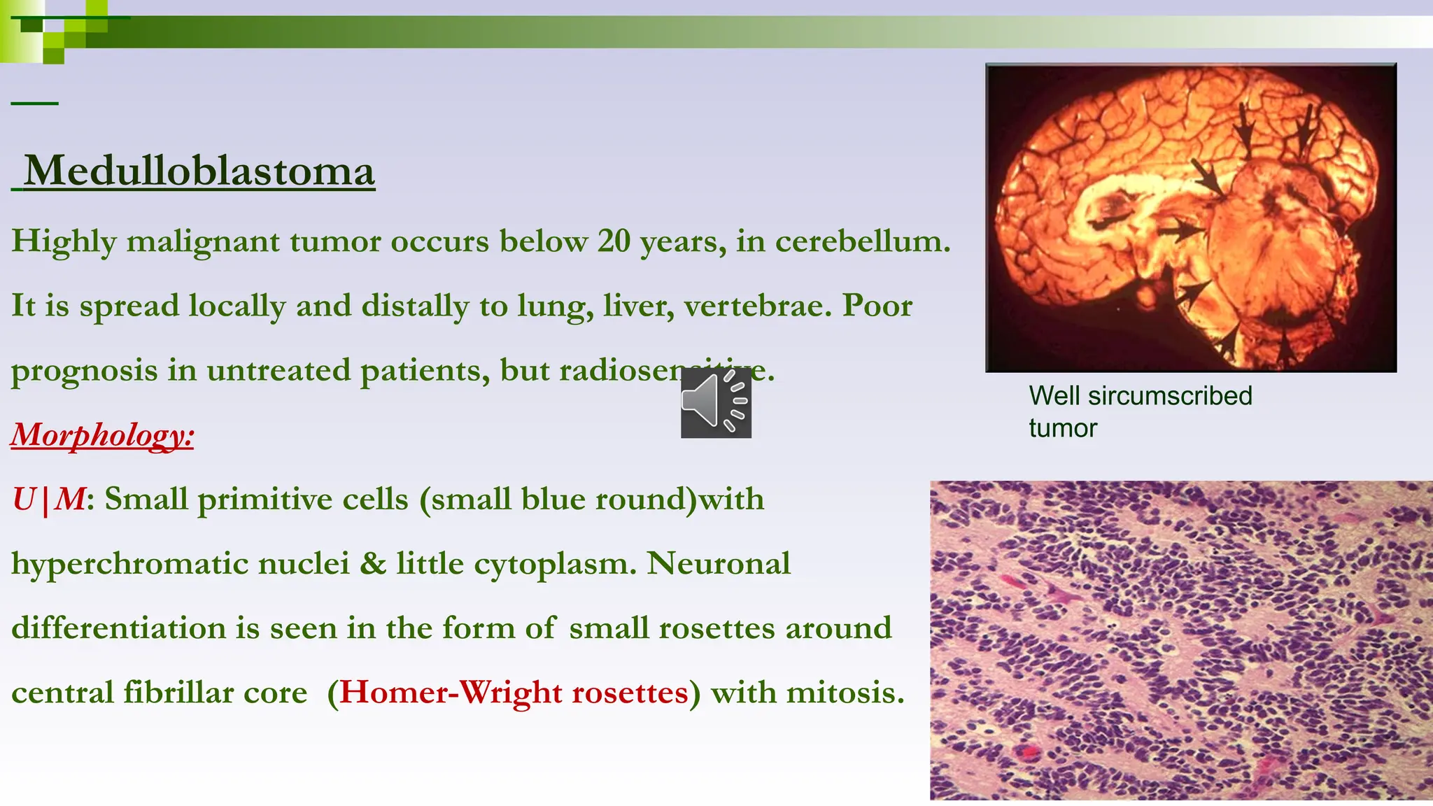 Medulloblastoma
Highly malignant tumor occurs below 20 years, in cerebellum.
It is spread locally and distally to lung, liver, vertebrae. Poor
prognosis in untreated patients, but radiosensitive.
Morphology:
U|M: Small primitive cells (small blue round)with
hyperchromatic nuclei & little cytoplasm. Neuronal
differentiation is seen in the form of small rosettes around
central fibrillar core (Homer-Wright rosettes) with mitosis.
Well sircumscribed
tumor
 