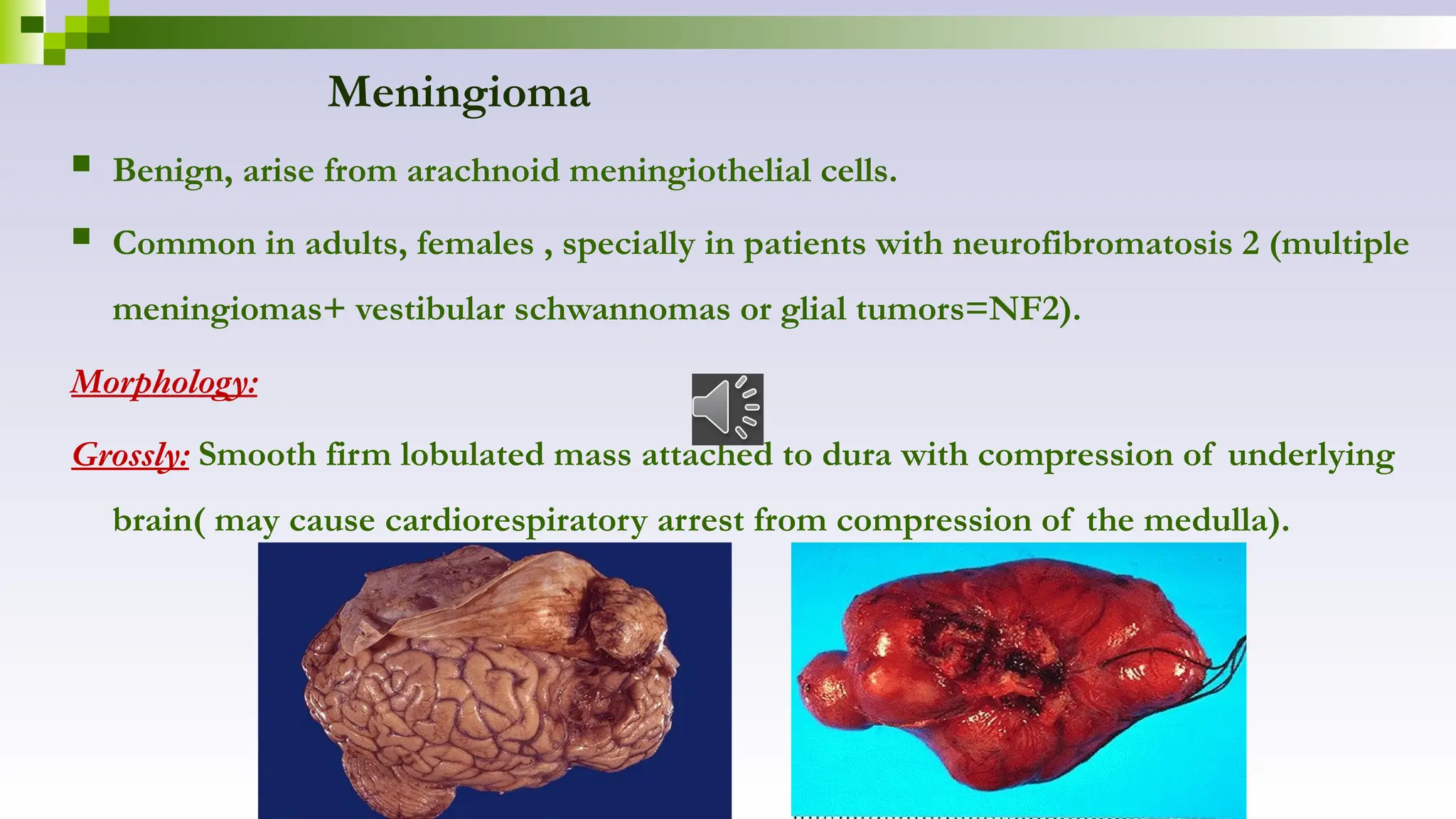 Meningioma
 Benign, arise from arachnoid meningiothelial cells.
 Common in adults, females , specially in patients with neurofibromatosis 2 (multiple
meningiomas+ vestibular schwannomas or glial tumors=NF2).
Morphology:
Grossly: Smooth firm lobulated mass attached to dura with compression of underlying
brain( may cause cardiorespiratory arrest from compression of the medulla).
 