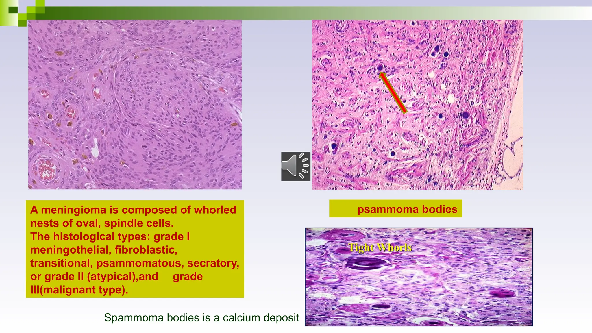A meningioma is composed of whorled
nests of oval, spindle cells.
The histological types: grade I
meningothelial, fibroblastic,
transitional, psammomatous, secratory,
or grade II (atypical),and grade
III(malignant type).
psammoma bodies
Spammoma bodies is a calcium deposit
 
