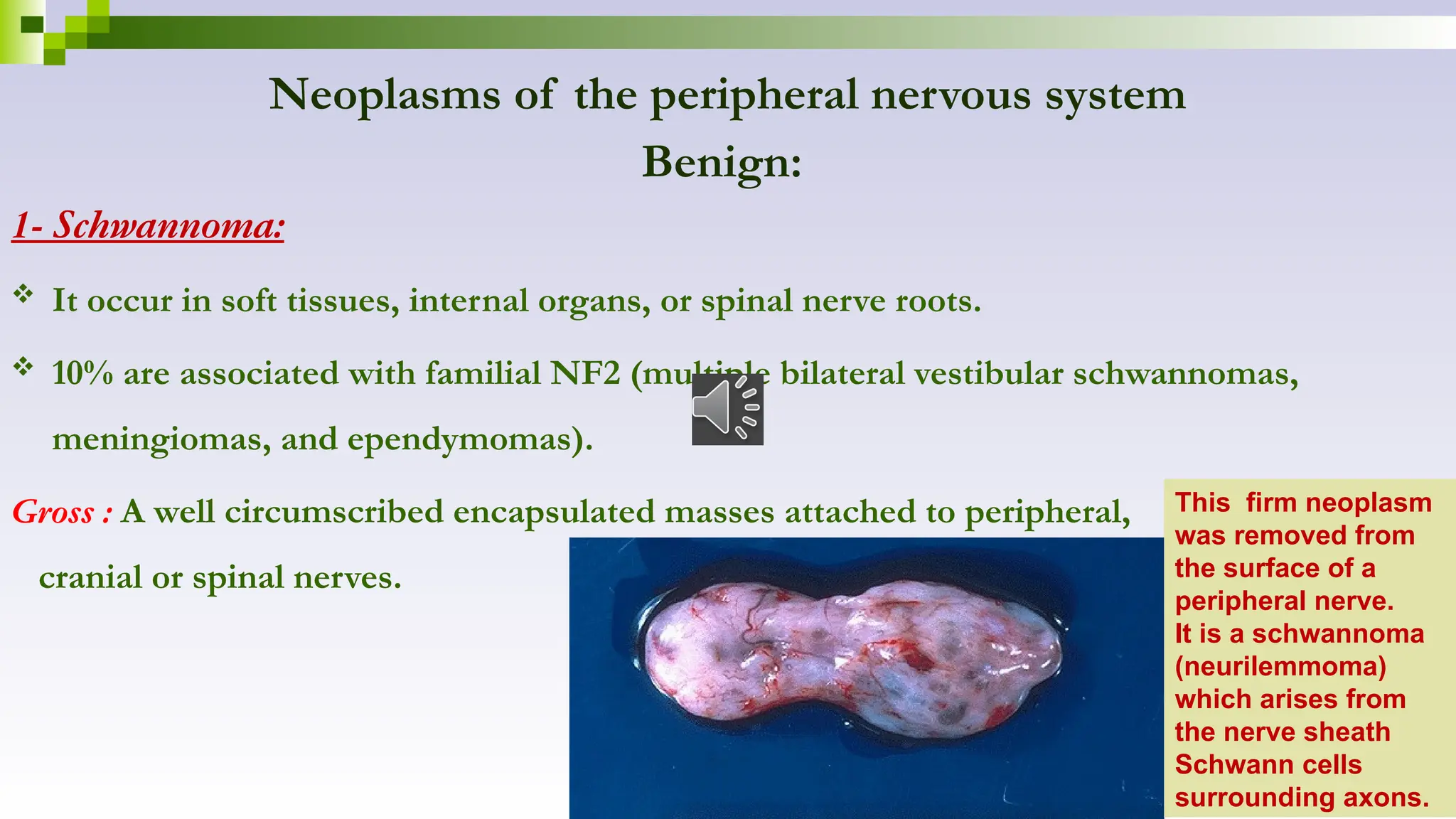 Neoplasms of the peripheral nervous system
Benign:
1- Schwannoma:
 It occur in soft tissues, internal organs, or spinal nerve roots.
 10% are associated with familial NF2 (multiple bilateral vestibular schwannomas,
meningiomas, and ependymomas).
Gross : A well circumscribed encapsulated masses attached to peripheral,
cranial or spinal nerves.
This firm neoplasm
was removed from
the surface of a
peripheral nerve.
It is a schwannoma
(neurilemmoma)
which arises from
the nerve sheath
Schwann cells
surrounding axons.
 