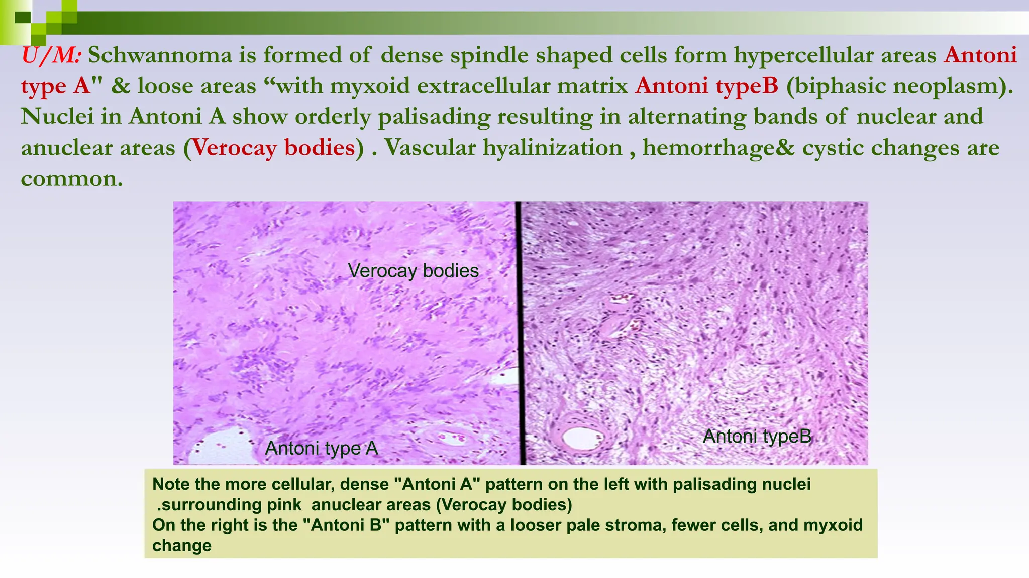 U/M: Schwannoma is formed of dense spindle shaped cells form hypercellular areas Antoni
type A" & loose areas “with myxoid extracellular matrix Antoni typeB (biphasic neoplasm).
Nuclei in Antoni A show orderly palisading resulting in alternating bands of nuclear and
anuclear areas (Verocay bodies) . Vascular hyalinization , hemorrhage& cystic changes are
common.
Note the more cellular, dense "Antoni A" pattern on the left with palisading nuclei
surrounding pink anuclear areas (Verocay bodies)
.
On the right is the "Antoni B" pattern with a looser pale stroma, fewer cells, and myxoid
change
Antoni type A
Verocay bodies
Antoni typeB
 