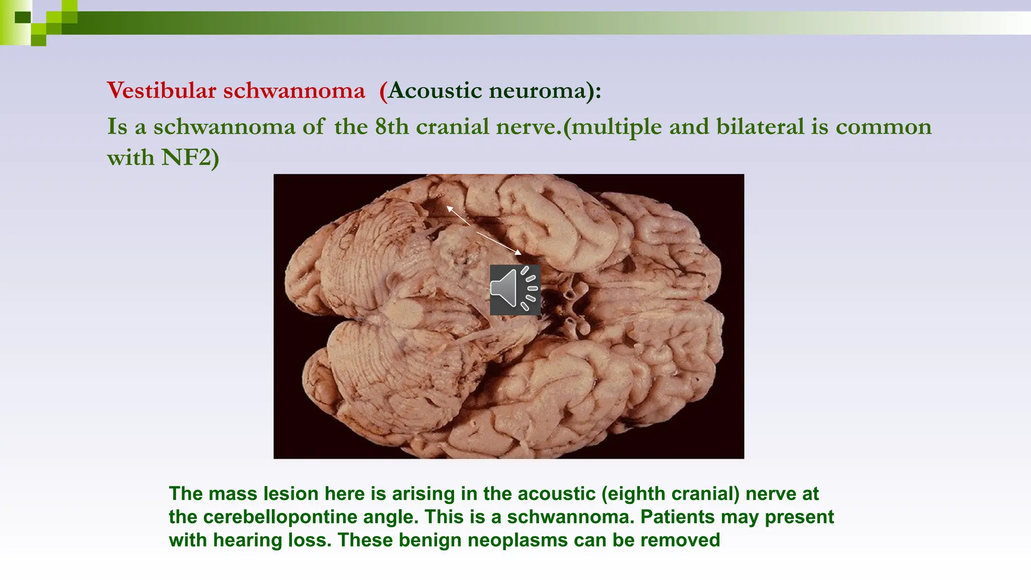Vestibular schwannoma (Acoustic neuroma):
Is a schwannoma of the 8th cranial nerve.(multiple and bilateral is common
with NF2)
The mass lesion here is arising in the acoustic (eighth cranial) nerve at
the cerebellopontine angle. This is a schwannoma. Patients may present
with hearing loss. These benign neoplasms can be removed
 
