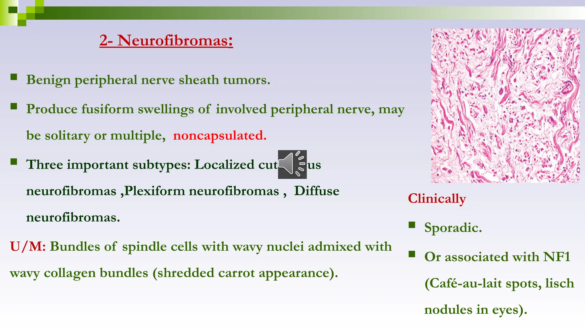 2- Neurofibromas:
Clinically
 Sporadic.
 Or associated with NF1
(Café-au-lait spots, lisch
nodules in eyes).
 Benign peripheral nerve sheath tumors.
 Produce fusiform swellings of involved peripheral nerve, may
be solitary or multiple, noncapsulated.
 Three important subtypes: Localized cutaneous
neurofibromas ,Plexiform neurofibromas , Diffuse
neurofibromas.
U/M: Bundles of spindle cells with wavy nuclei admixed with
wavy collagen bundles (shredded carrot appearance).
 