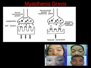 Myasthenia Gravis 