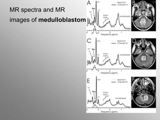 MR spectra and MR
images of medulloblastoma
 