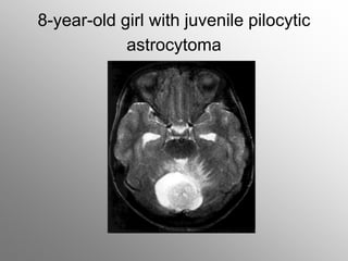 8-year-old girl with juvenile pilocytic
astrocytoma
 