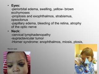• Eyes:
-periorbital edema, swelling, yellow- brown
ecchymoses
-proptosis and exophthalmos, strabismus,
opsoclonus
-papillary edema, bleeding of the retina, atrophy
of the optic nerve
• Neck:
-cervical lymphadenopathy
-supraclavicular tumor
-Horner syndrome: enophthalmos, miosis, ptosis,
Raccon eyes
 