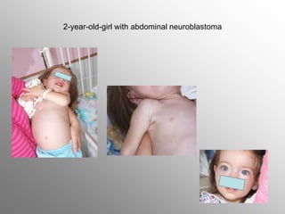 2-year-old-girl with abdominal neuroblastoma
 