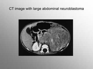 CT image with large abdominal neuroblastoma
 