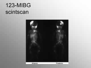 123-MIBG
scintscan
 