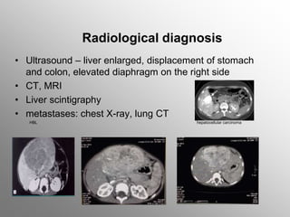 Radiological diagnosis
• Ultrasound – liver enlarged, displacement of stomach
and colon, elevated diaphragm on the right side
• CT, MRI
• Liver scintigraphy
• metastases: chest X-ray, lung CT
HBL hepatocellular carcinoma
 