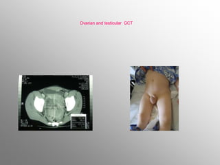 Ovarian and testicular GCT
 