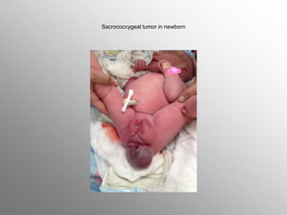 Sacrococcygeal tumor in newborn
 
