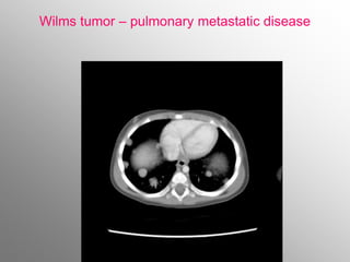 Wilms tumor – pulmonary metastatic disease
 