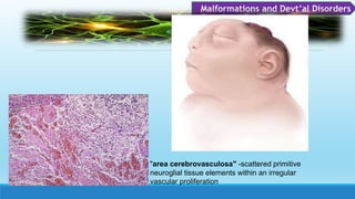 Malformations and Devt’al Disorders
"area cerebrovasculosa" -scattered primitive
neuroglial tissue elements within an irregular
vascular proliferation
 