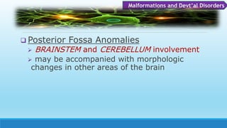  Posterior Fossa Anomalies
 BRAINSTEM and CEREBELLUM involvement
 may be accompanied with morphologic
changes in other areas of the brain
Malformations and Devt’al Disorders
 