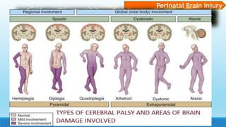 Perinatal Brain Injury
 