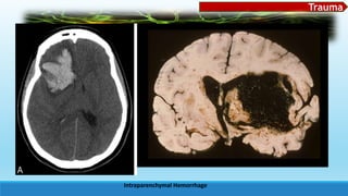 Trauma
Intraparenchymal Hemorrhage
 
