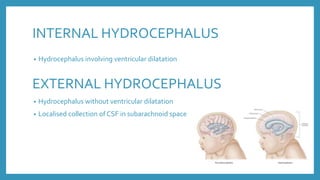 INTERNAL HYDROCEPHALUS
• Hydrocephalus involving ventricular dilatation
EXTERNAL HYDROCEPHALUS
• Hydrocephalus without ventricular dilatation
• Localised collection of CSF in subarachnoid space
 