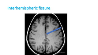 Interhemispheric fissure
 