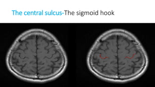 The central sulcus-The sigmoid hook
 