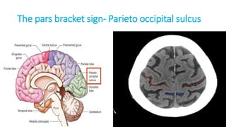 The pars bracket sign- Parieto occipital sulcus
 