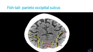 Fish tail- parieto occipital sulcus
 