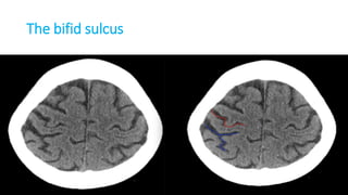 The bifid sulcus
 
