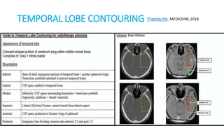 TEMPORAL LOBE CONTOURING Francis Ho, MEDICEINE,2018
 