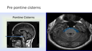 Pre pontine cisterns
 