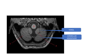 TONSIL
CEREBELLAR
HEMISPHERE
 