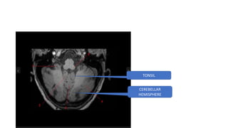 TONSIL
CEREBELLAR
HEMISPHERE
 