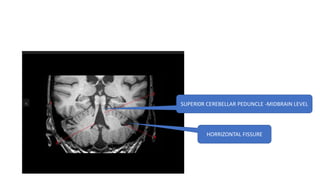 SUPERI0R CEREBELLAR PEDUNCLE -MIDBRAIN LEVEL
HORRIZONTAL FISSURE
 