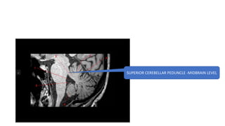 SUPERIOR CEREBELLAR PEDUNCLE -MIDBRAIN LEVEL
 