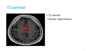 T1 contrast
• T1 contrast • T1 contrast
• Vessels -hyperintense
30
 
