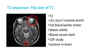 T2 sequence- Flip side of T1
•T2
• CSF, AQ/VT HUMOR WHITE
•Fat black/white mater
•Water white
•Blood vessel dark
•CSF study
•Lesions in brain
31
 