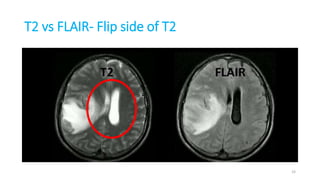 T2 vs FLAIR- Flip side of T2
33
 