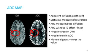ADC MAP
• Apparent diffusion coefficient
• Statistical measure of restriction
• ADC measuring the diffusion
• ADC without T2 effect –black
• Hyperintense on DWI
• Hypointense in ADC
• More malignant –lower the
value
36
 