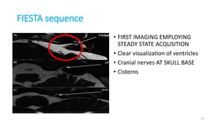 FIESTA sequence
• FIRST IMAGING EMPLOYING
STEADY STATE ACQUSITION
• Clear visualization of ventricles
• Cranial nerves AT SKULL BASE
• Cisterns
42
 