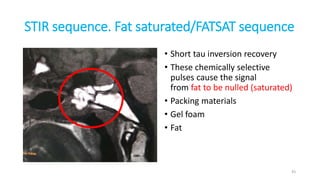 STIR sequence. Fat saturated/FATSAT sequence
• Short tau inversion recovery
• These chemically selective
pulses cause the signal
from fat to be nulled (saturated)
• Packing materials
• Gel foam
• Fat
43
 