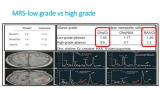 MRS-low grade vs high grade
46
 