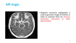 MR Angio
• Magnetic resonance angiography is
used to generate images of arteries in
order to evaluate them for stenosis,
occlusions, aneurysms or other
abnormalities
48
 