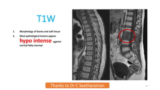T1W
1. Morphology of bones and soft tissue
2. Most pathological lesions appear
hypo intense against
normal fatty marrow
Thanks to Dr C Seetharaman 62
 