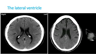 The lateral ventricle
 