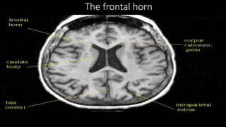The frontal horn
 