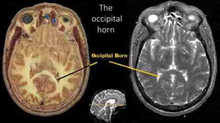 The
occipital
horn
 