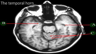 The temporal horn
 